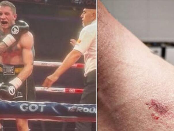 Albanski bokser ugrizao srpskog borca u ringu