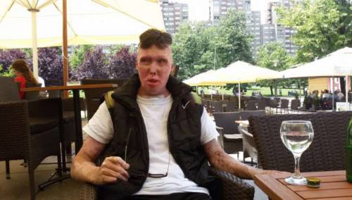 Aldin Jacić ponovo mora na operativni zahvat