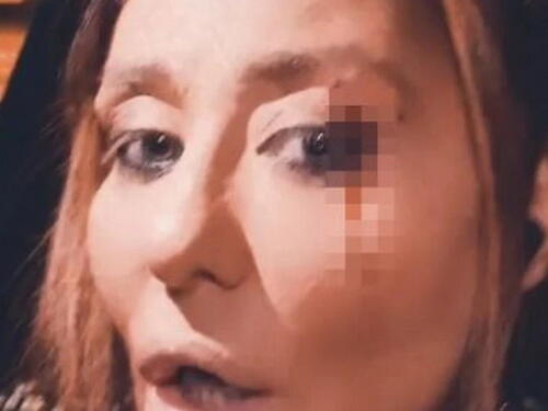 Ana Nikolić brutalno pretučena, pokazala jezive povrede na licu