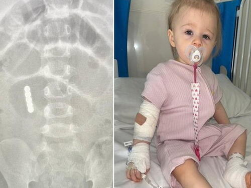 Beba progutala šest magneta, spašena nakon teške operacije