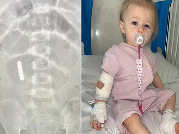 Beba progutala šest magneta, spašena nakon teške operacije