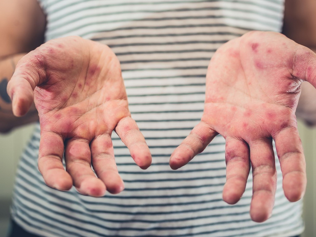 Beč bilježi porast ospica i hepatitisa, vlasti izdale upozorenje