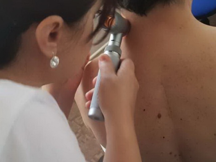 Besplatni preventivni pregledi kože u ZDK-u, maj u znaku ranog otkrivanja melanoma