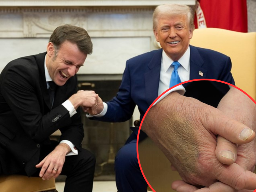 Bijela kuća: Trumpova modrica na ruci posljedica rukovanja, ne terapije