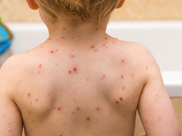 Broj djece oboljele od morbila u opadanju, vakcinacija se redovno obavlja