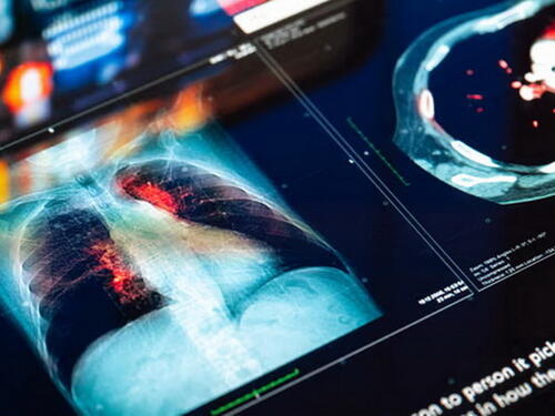 Broj slučajeva tumora kod mlađih od 50 porastao za gotovo 80 posto