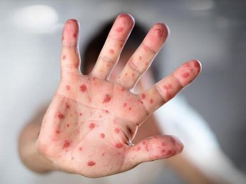 Broj zaraženih morbilima u ZDK opao, ali je ostao 'epidemijski rep'