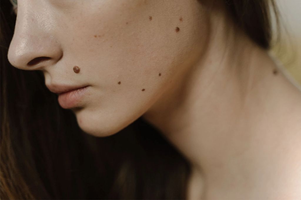 CIM: Kuba razvila lijek protiv melanoma
