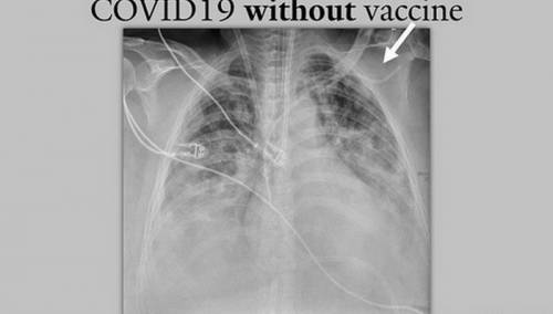 Covid pluća s vakcinom i bez primljene vakcine