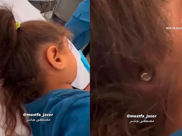 Djevojčica iz Gaze preživjela pogodak metkom u glavu