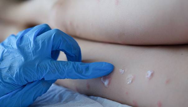 Do sada 80 osoba zaraženo majmunskim boginjama