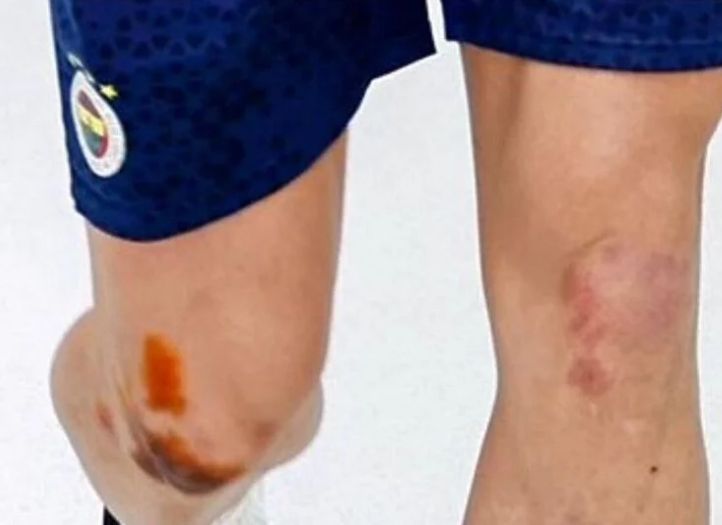 Edin Džeko završio u modricama nakon jučerašnje utakmice