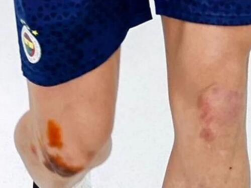 Edin Džeko završio u modricama nakon jučerašnje utakmice
