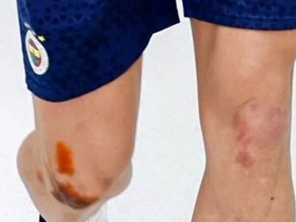 Edin Džeko završio u modricama nakon jučerašnje utakmice