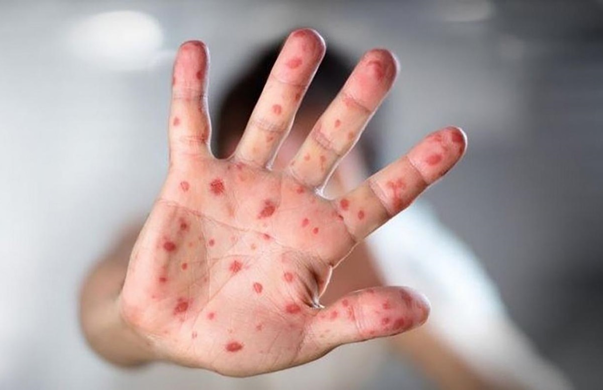 Epidemija morbila u RS-u: U Bijeljini i Banjaluci zaražene 52 osobe
