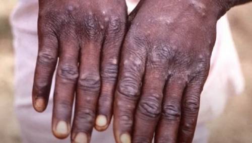 EU kupuje vakcine i pilule protiv majmunskih boginja