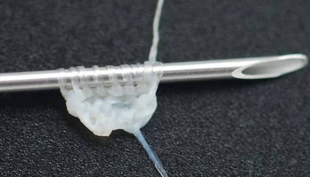 Francuski naučnici napravili konac od ćelija ljudske kože