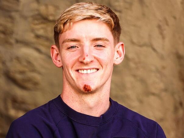 Fudbaler Engleske na press došao sa modricama, ubrzo je stiglo objašnjenje