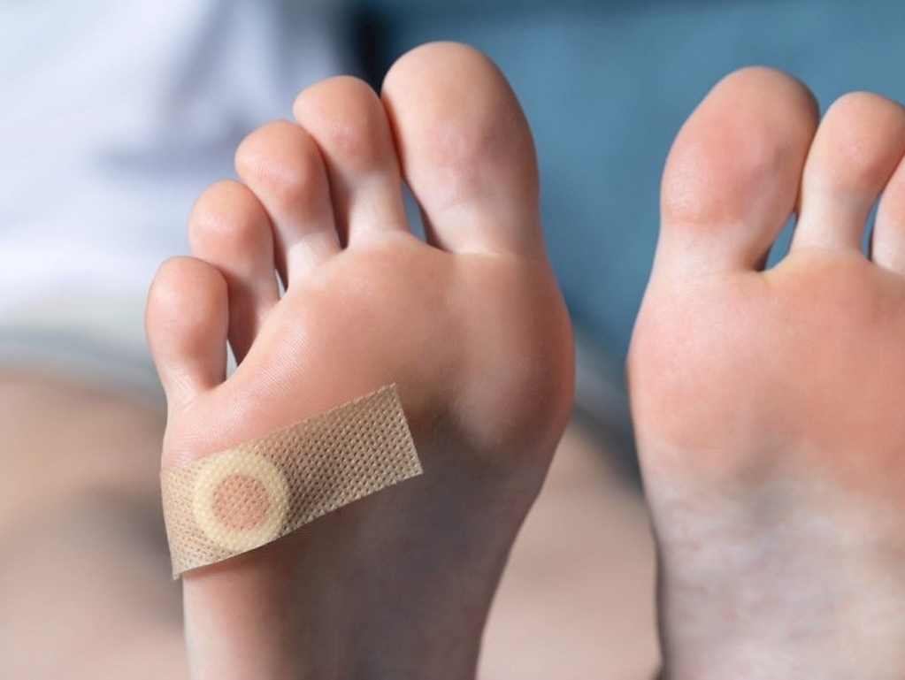 Imate kurje oko? Ovo su prirodni načini za ublažavanje tegoba