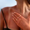 Izgorjeli ste na suncu? Dermatolozi: Odmah uradite...