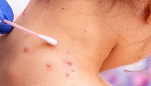 Izrael i Švicarska potvrdili slučajeve majmunskih boginja