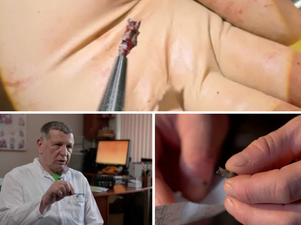 "Izvadili su mi šrapnel iz srca" – magneti koji spašavaju živote u Ukrajini