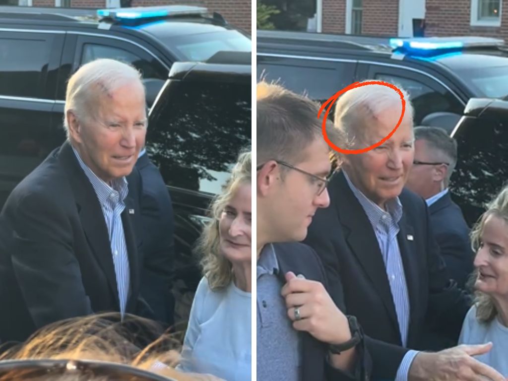 Joe Biden operisao karcinom, snimljen sa velikom ranom na glavi