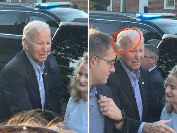 Joe Biden operisao karcinom, snimljen sa velikom ranom na glavi