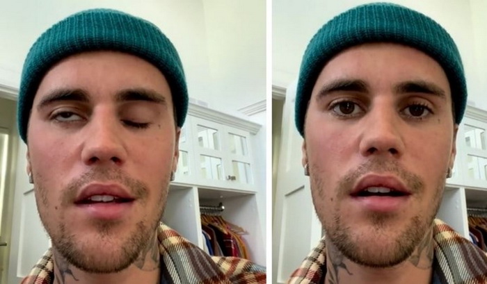 Justin Biber pokazao da mu je jedna strana lica potpuno paralizirana