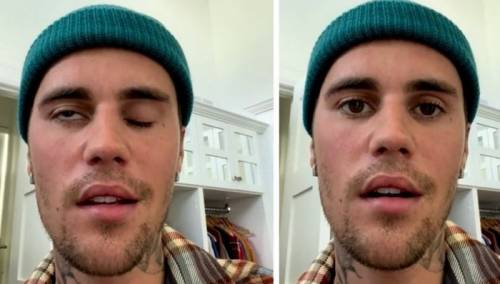 Justin Biber pokazao da mu je jedna strana lica potpuno paralizirana