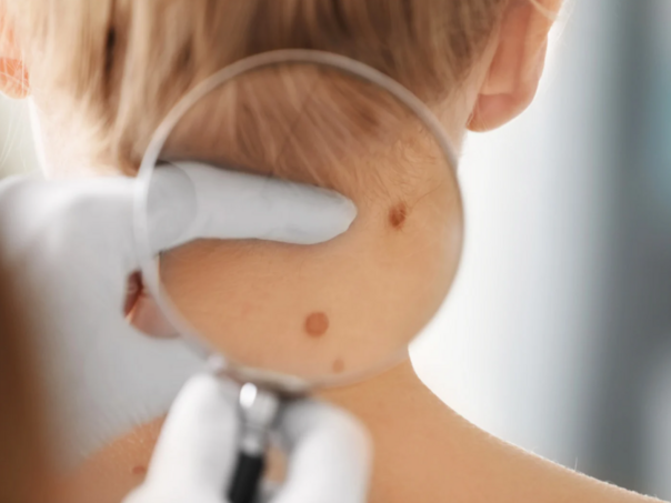 Kako prepoznati melanom, od samopregleda do dijagnoze