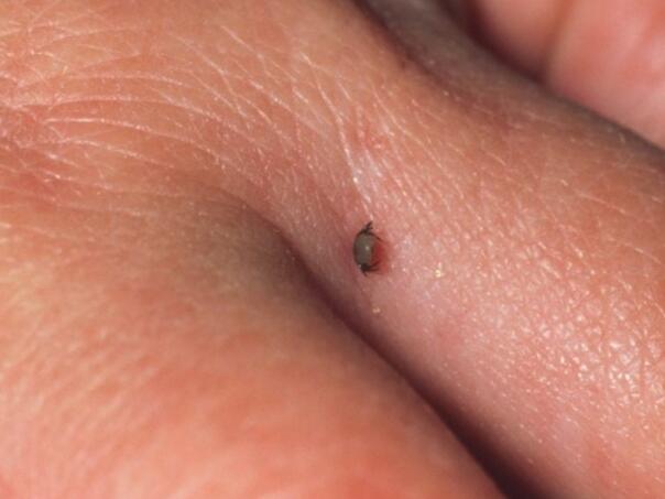 Kako sam otkrio da imam hroničnu lajmsku bolest? Decenije čekanja na dijagnozu