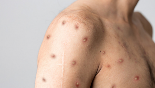 Kako se prenose majmunske boginje i koji su simptomi