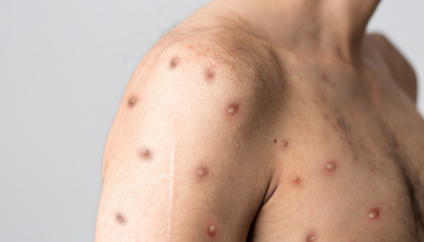 Kako se prenose majmunske boginje i koji su simptomi