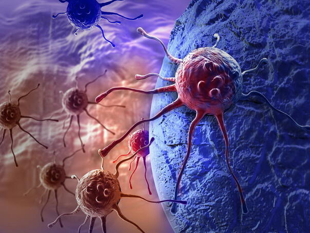 Karcinom debelog crijeva treći po učestalosti kod muškaraca i žena