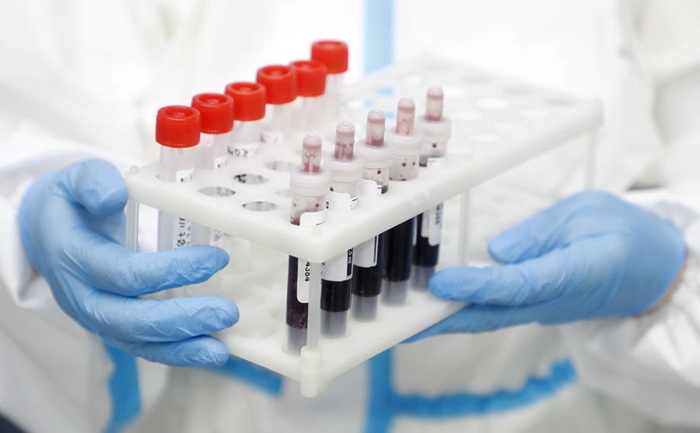 KCUS: Testirana 134 uzorka, 21 pozitivan
