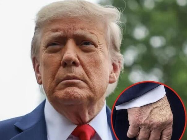 Koliko je ozbiljna dijagnoza Donalda Trumpa?