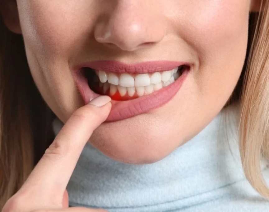 Krvarenje desni nije bezazleno: Možda vam nedostaje ovaj važan vitamin