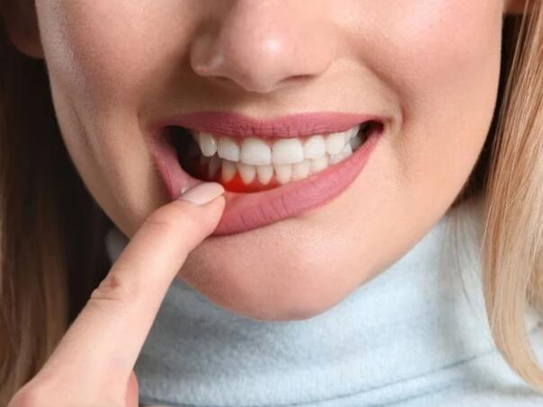Krvarenje desni nije bezazleno: Možda vam nedostaje ovaj važan vitamin