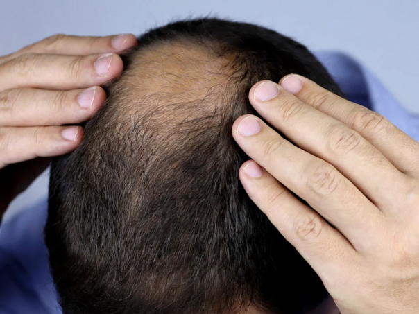 Revolucija: Lijek za opadanje kose bliže nego ikad