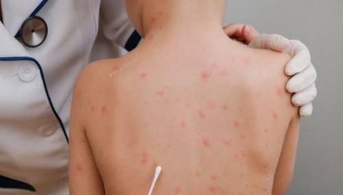 Male boginje u Srbiji: Broj imuniziranih mali, pooštrene mjere nadzora