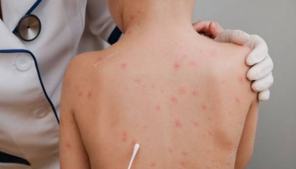 Male boginje u Srbiji: Broj imuniziranih mali, pooštrene mjere nadzora