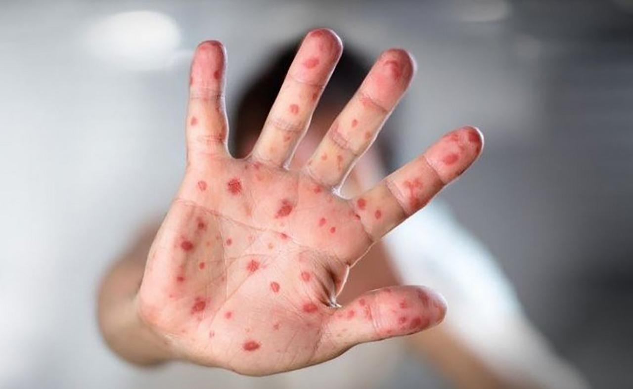 Ministarstvo ZDK zatražilo ukidanje epidemije morbila u tom kantonu