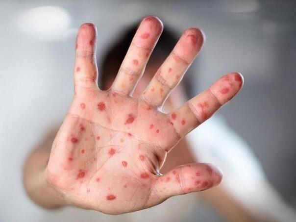 Ministarstvo ZDK zatražilo ukidanje epidemije morbila u tom kantonu