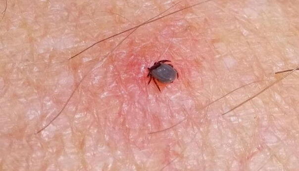 Mlada žena u Sjevernoj Makedoniji umrla poslije ujeda krpelja