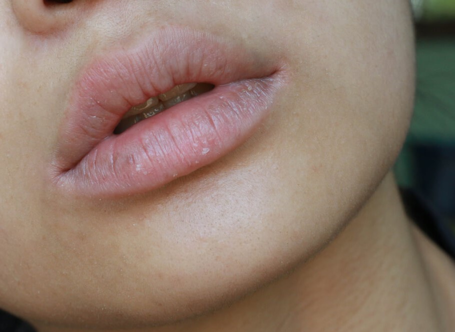 Modre usne ukazuju na ozbiljne srčane probleme