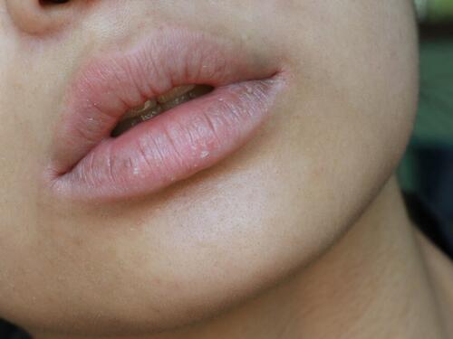 Modre usne ukazuju na ozbiljne srčane probleme