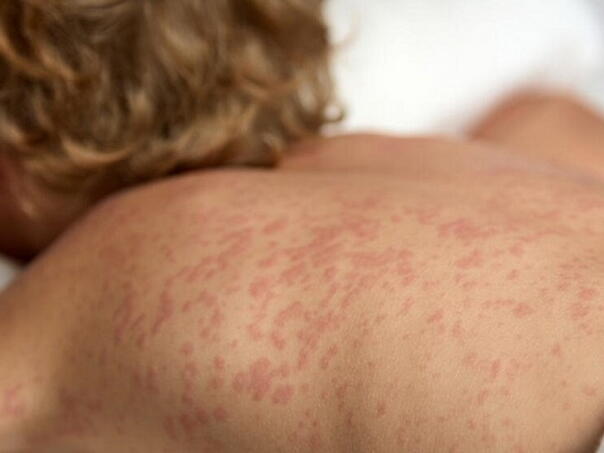 Morbilima zaražene 44 osobe u RS, najviše oboljelih djeca, petoro hospitalizovano