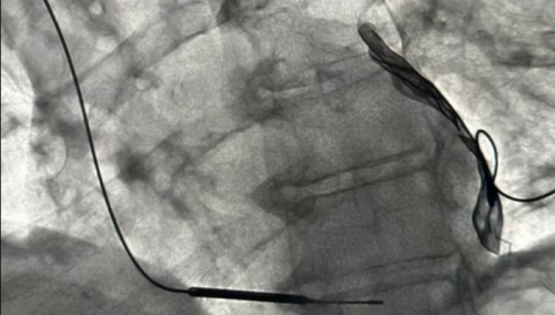 Na KCUS prvi slučaj ugradnje uređaja za mikrostrujnu terapiju srca