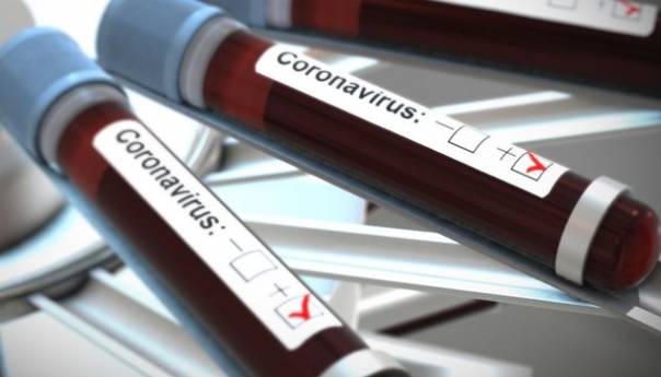 Na KCUS-u testirano 65 uzoraka, 15 pozitivnih na COVID-19